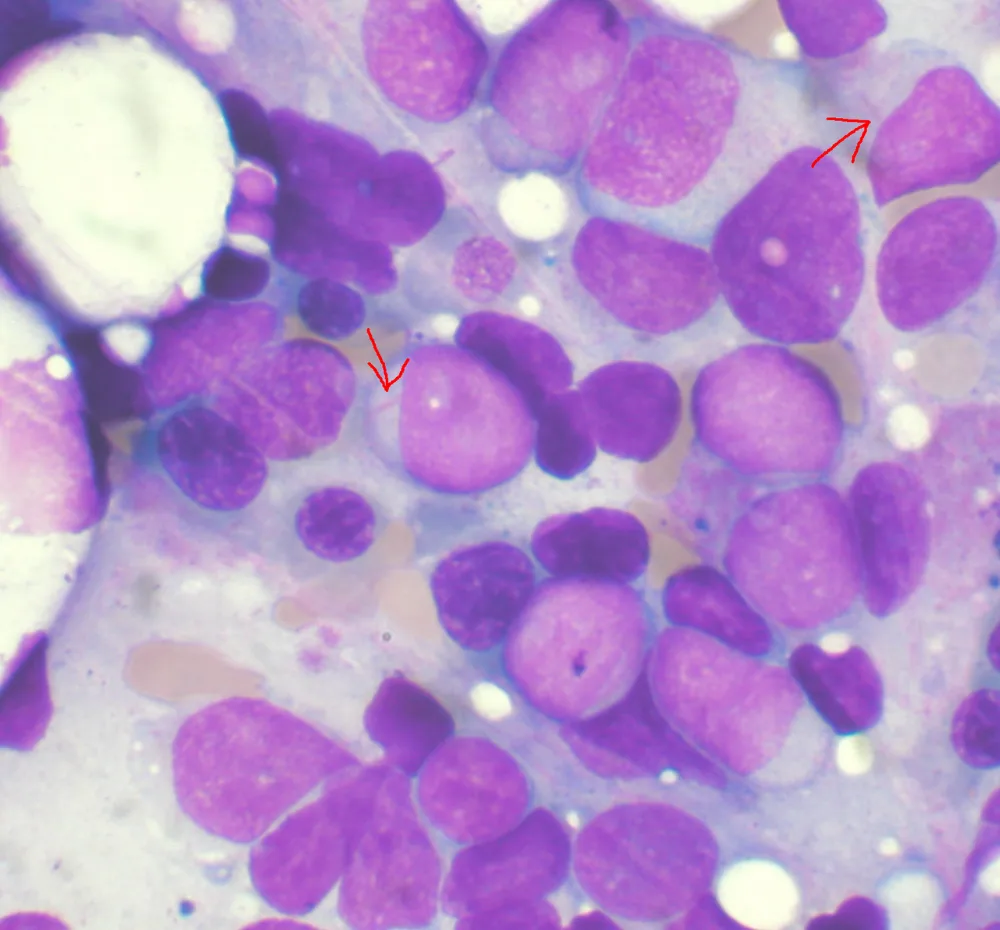 Bone marrow aspirate in AML with blasts containing Auer rods
