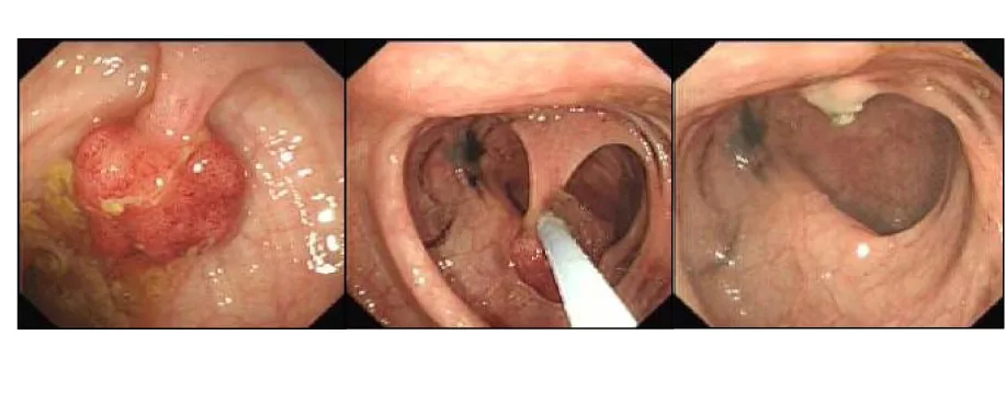 Three colonoscopy images showing a bowel polyp being found and removed