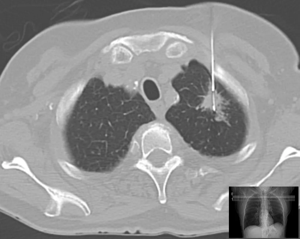 CT scan during a lung biopsy showing the biopsy needle in a lung mass