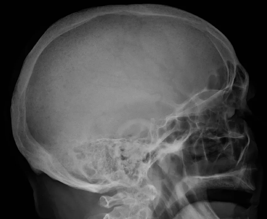 Plain skull X-ray with multiple round dark lesions in myeloma